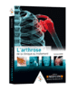 L'arthrose